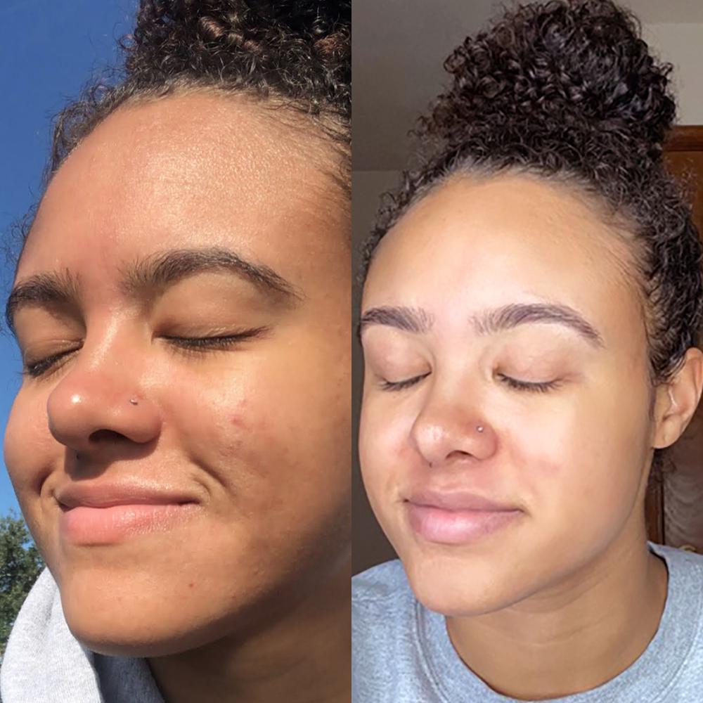 Aspen Bark Exfoliation Treatment