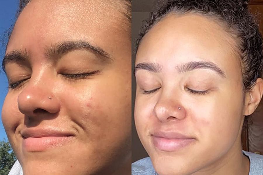 Aspen Bark Exfoliation Treatment